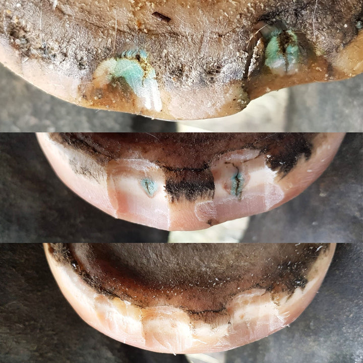 Seedy toe resected after using Blue Balls